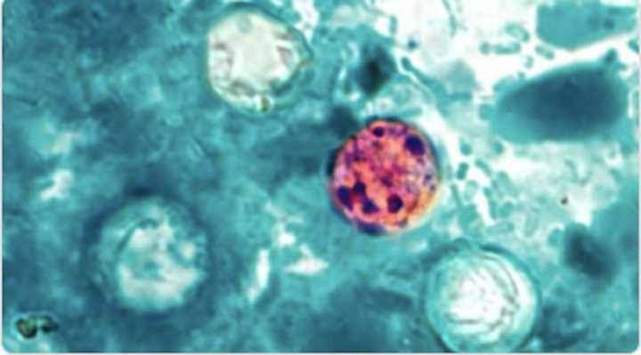 CDC logo and warning sign about Cyclospora parasite outbreak linked to iceberg lettuce contamination.