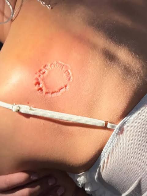 Close-up view of a shoulder injury mark submitted as evidence in the civil lawsuit against NFL player Puka Nacua.