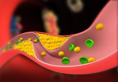 Anatomical illustration showing a cross-section of a human artery with cholesterol plaque buildup.