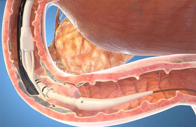 Fractyl Health's Revita endoscopic catheter performing hydrothermal ablation on the duodenal mucosa.
